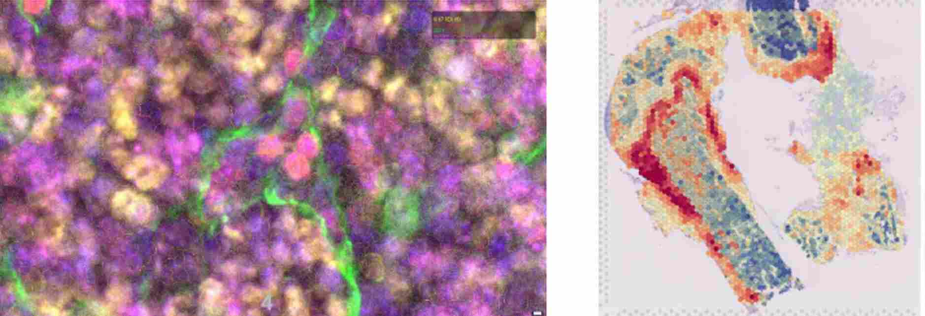 Coupe fémurs leucémiques - Équipe Interactions Leuco/Stromales dans l’hématopoïèse normale et pathologique - CRCM
